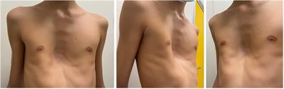 Case Report: Double Pectus Up in severe pectus excavatum, the new frontier of modified taulinoplasty